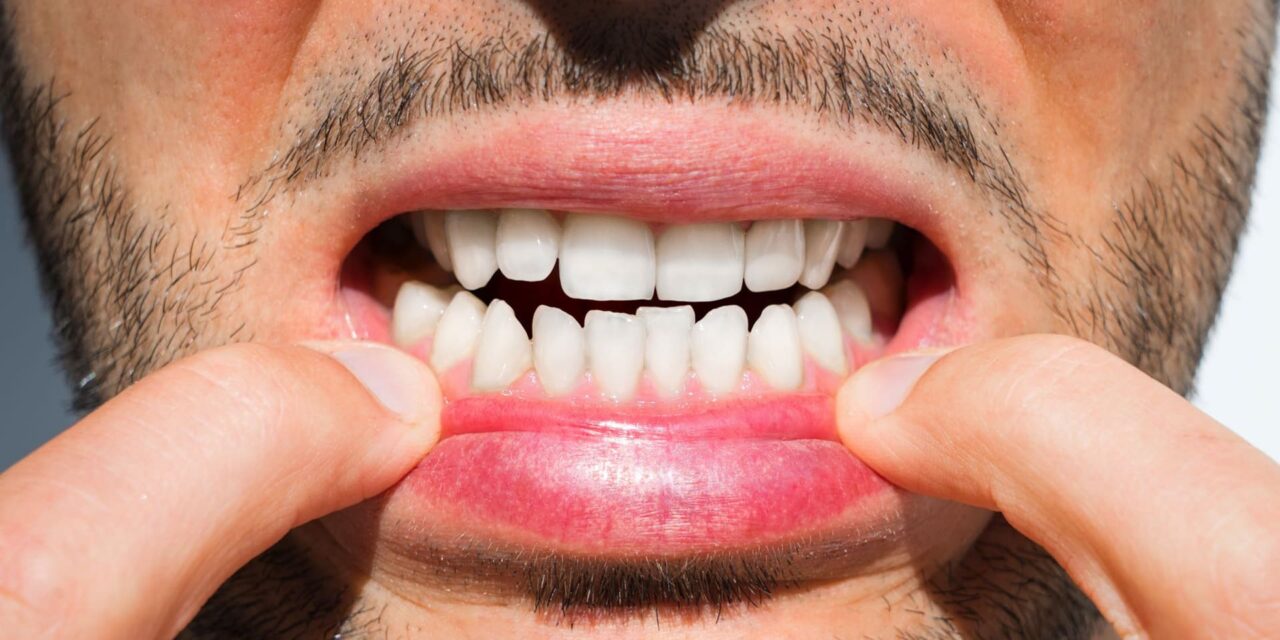 Se i miei denti sono troppo affollati è solo un problema estetico?