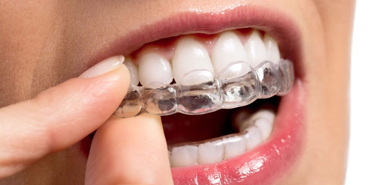 Prima settimana con Invisalign? 5 suggerimenti per partire con il piede giusto!